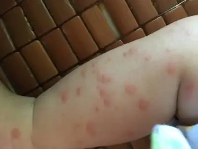 宝妈们这是给虫咬的?_宝宝树