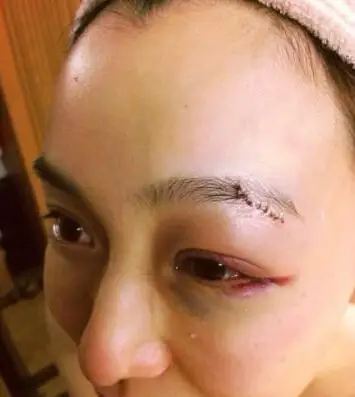 > 正文  [摘要]"snh48"23岁成员唐安琪与朋友在咖啡店聚会时惨遭烧伤