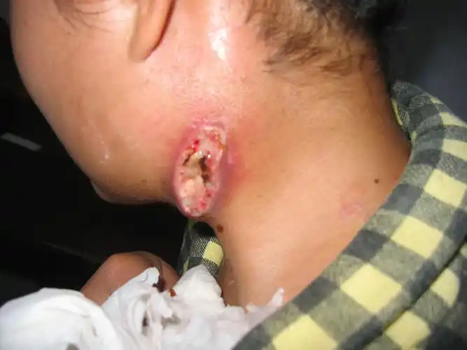 ██ 淋巴结核患者治疗病例跟踪之三█ █ - hdxyy