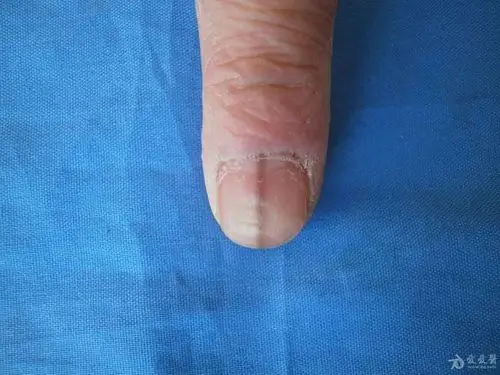 病例分享待排甲母痣