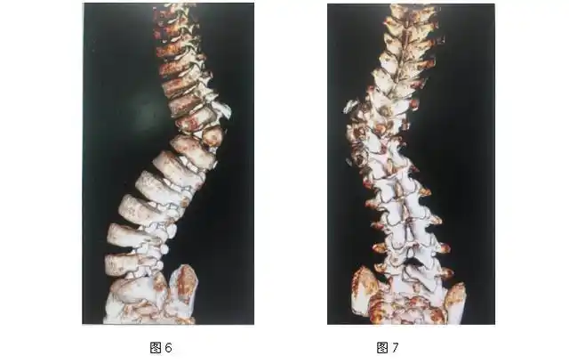 发现孩子先天性脊柱侧凸怎么办?