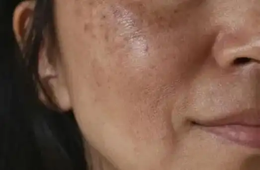 美白|色斑|防晒|晒斑|敏感肌肤_网易订阅