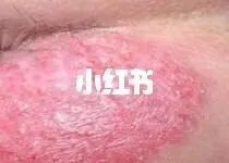 然后趁热熏洗患处,待药液变温时,可坐浴,一天两次,适用于肛门湿疹