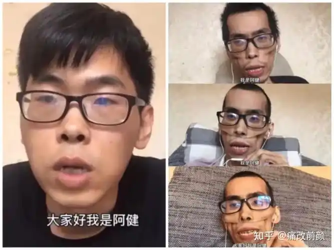 这个看起来很健壮的男人被直肠癌折磨得骨瘦如柴.