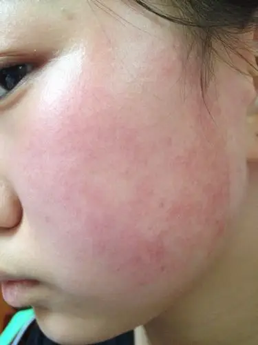 脸泛红 去医院检查得出是过敏性皮炎 觉得是自己吹热风的时间吹长了
