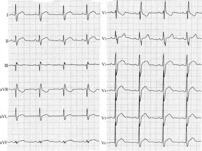 第81例 先天性心脏病,房间隔缺损,右束支传导阻滞,st段抬高【心电图