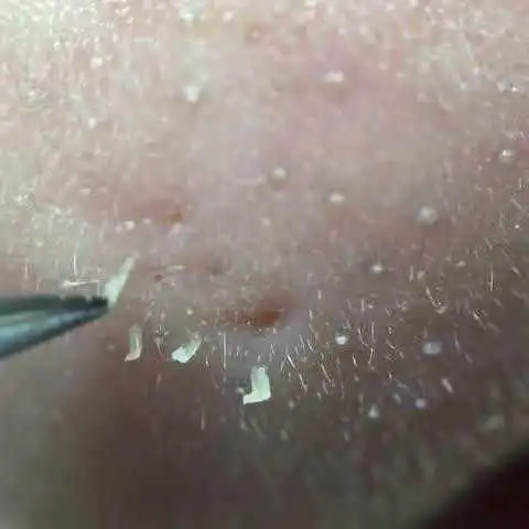 鼻子挤出的白色"条状物"是什么东西?如何清除?