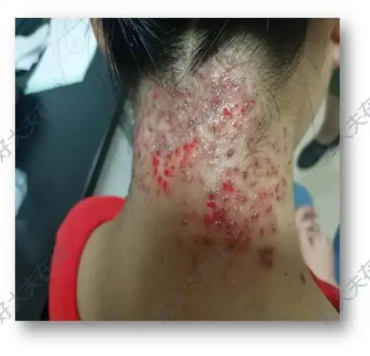 寻常疣光动力治疗_寻常疣 - 好大夫在线