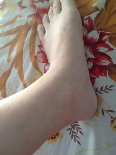 脚背有很多小红点,不痒不痛,按下去会消失几秒,越想越多,很害怕,急!