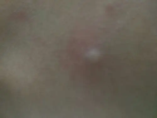 背部一粒状是什呢