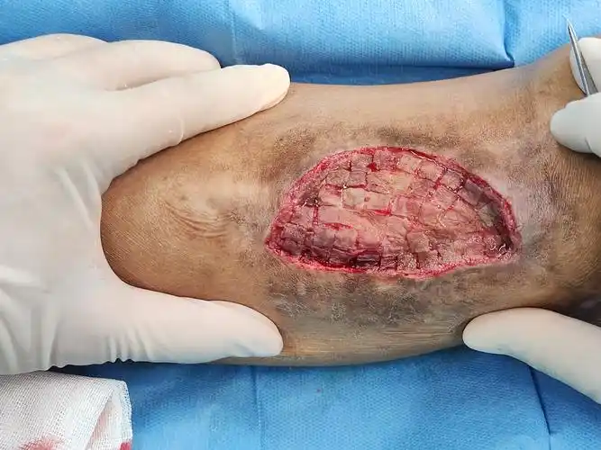 很多人认为:所谓植皮,就是把一块皮肤切下来,然后缝合到另外一个部位