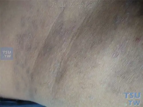扁平苔藓-色素性扁平苔藓:腹股沟,骶髂关节周围大小不等紫灰色斑疹