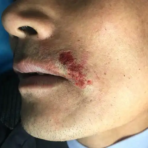 寻常疣激光治疗前后对比图