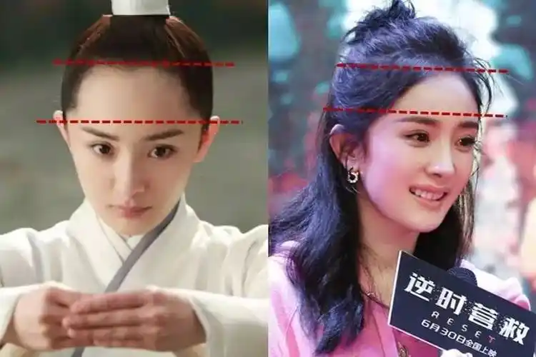 大幂幂真的去植发了对付高发际线还能有什么好法子