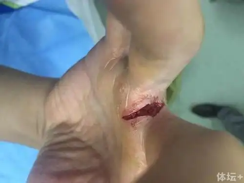 周琦右手再度受伤现正在医院进行缝针治疗