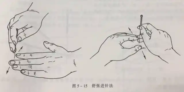 重庆六合学校:自学针灸的你,进针手法掌握清楚了吗