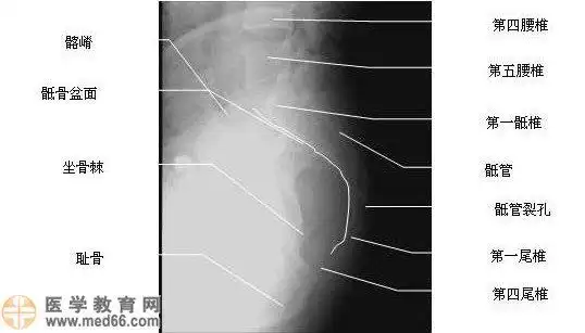 骶椎侧位-x线片