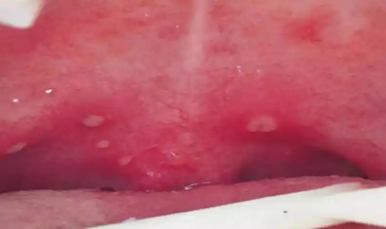 (舌体处小疱疹,图片来自uptodate)(口腔颊粘膜处小疱疹,图片来自upto