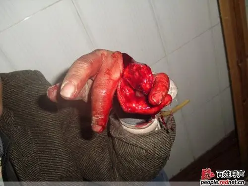 下面是我们砍伤后的图片希望大家能帮到我,我的电话号码是15173957531