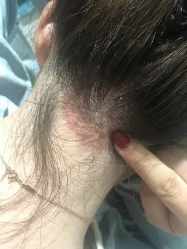 谁知道怎么回事,很痒还掉头皮屑特别厉害.