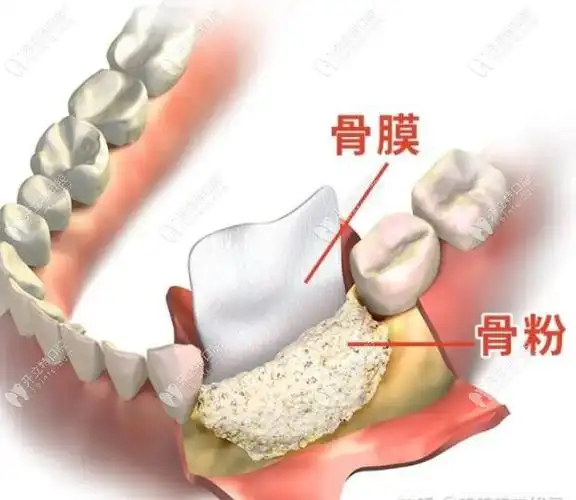 种植牙植入骨粉的价格一般根据牙槽骨缺损情况决定,价格由骨粉 骨膜