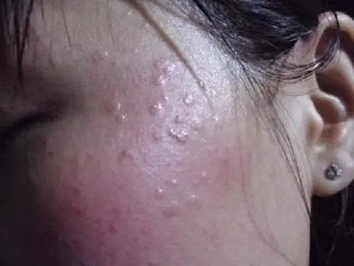 脸上皮肤癌症状和图