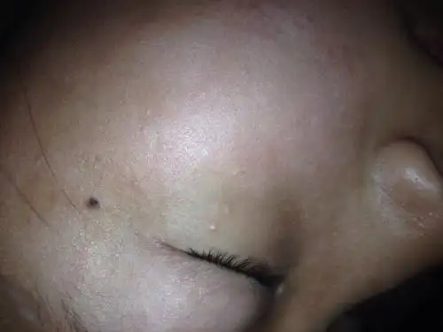 从小学三四年级脸上就长这种白疙瘩,请问是虫,还是脂肪粒,不痒.