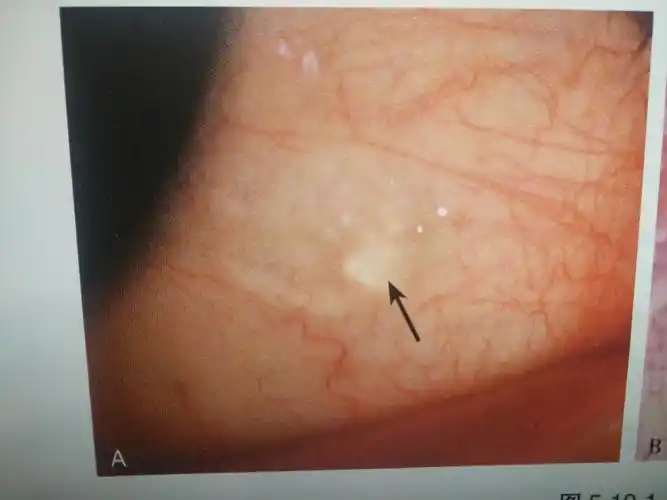 结膜淋巴滤泡. - 好大夫在线