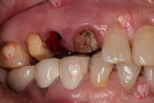 【病例讨论】cadm 氧化锆桩冠修复 [病例帖]