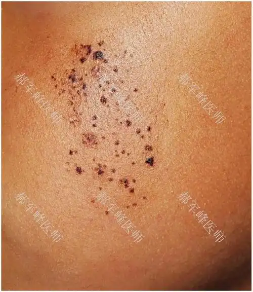 spitz痣主要见于儿童,表现为淡红色或棕色的丘疹,表面光滑,可以长期