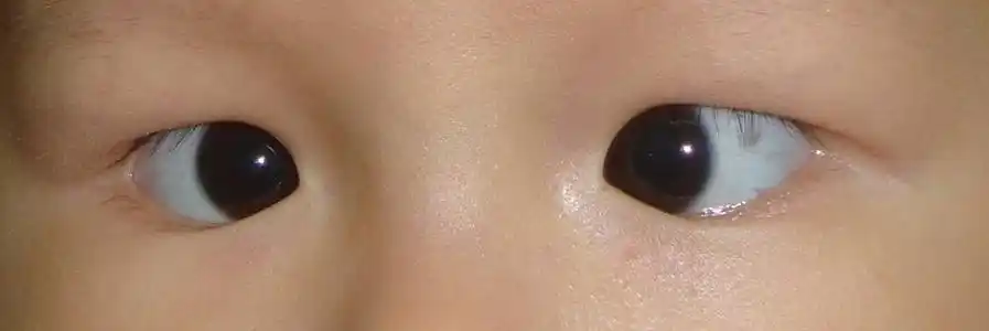 很多宝妈会问医生:"宝宝有斗鸡眼(对眼)要紧吗?