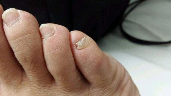 为什么小脚趾甲有两瓣?