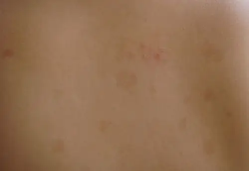 后背起的片状颜色较深不疼偶尔痒.越来越多.