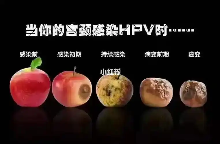 感染hpv病毒后的宫颈就像这个苹果96,你以为可以放久一点再吃