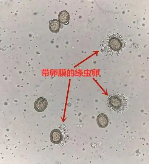 重口慎入,患者粪便里的超长带绦虫...|寄生虫|虫卵|囊尾蚴|虫体_网易