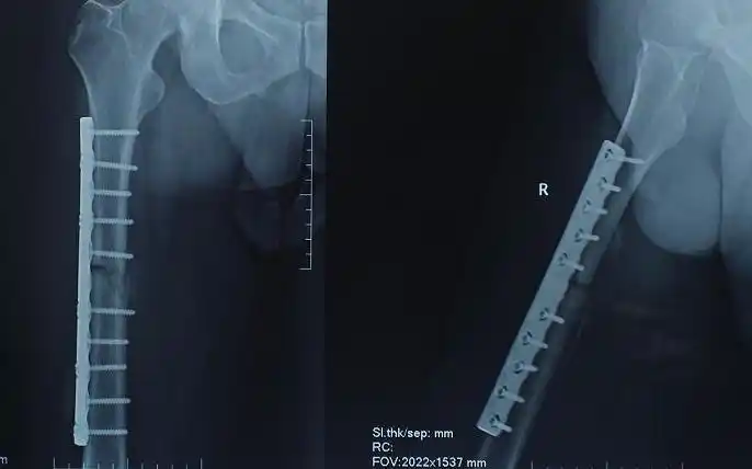 大腿骨折100天检查有少量骨痂.还会不会骨不连?