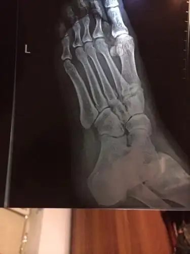 拍片子判断左足第一四跖骨基底部骨皮质连续性差,ct报告第四跖骨基