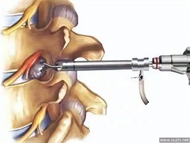 椎间孔镜手术微创治疗颈腰椎间盘突出症