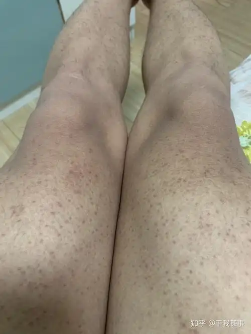 你是如何改善毛周角化(鸡皮肤)和鱼鳞病的? - 知乎