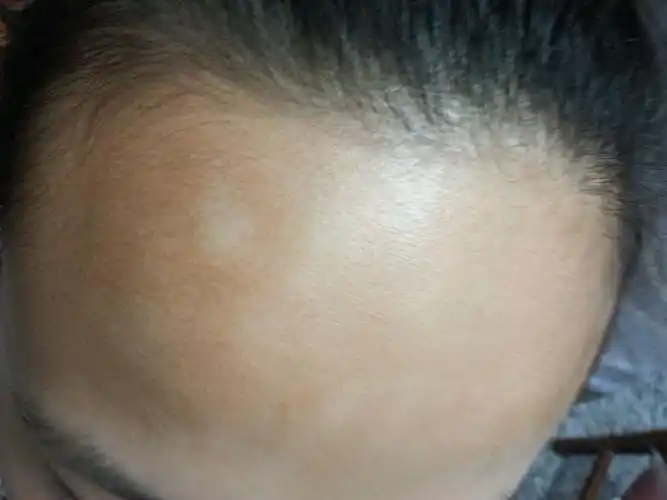 请哪位高人帮看一下这是什么斑,在额头上,不痛不痒,已有三四个月,以前