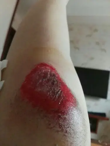 今天骑车摔伤了,校医处理了一下要注意什么才能不留疤