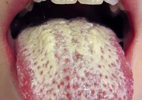 口腔念珠菌病图片