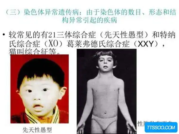 威廉斯氏综合症患上威廉斯氏综合症的人有一定几率会精神分裂