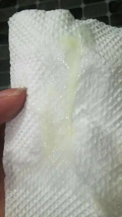 白带呈豆腐渣状图片6