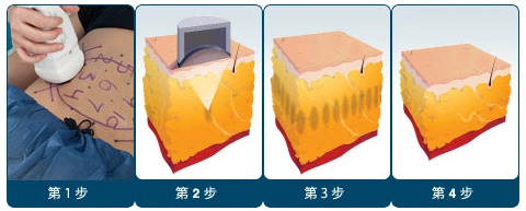 热立塑减肥原理示意图片