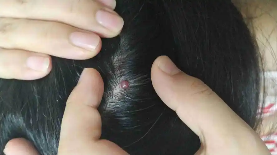 头皮上突然长了这个,会好吗?一定要手术去掉吗?