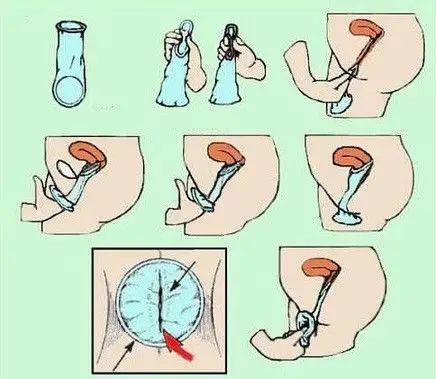 女用避孕套有点像以前的避孕膜避孕栓一类的东西,是塞在阴道里使用的.