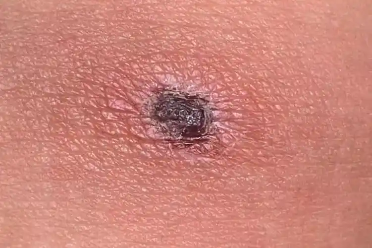 萧山女子几周前被虫咬,至今还在抢救!这几种致命毒虫,大家务必小心