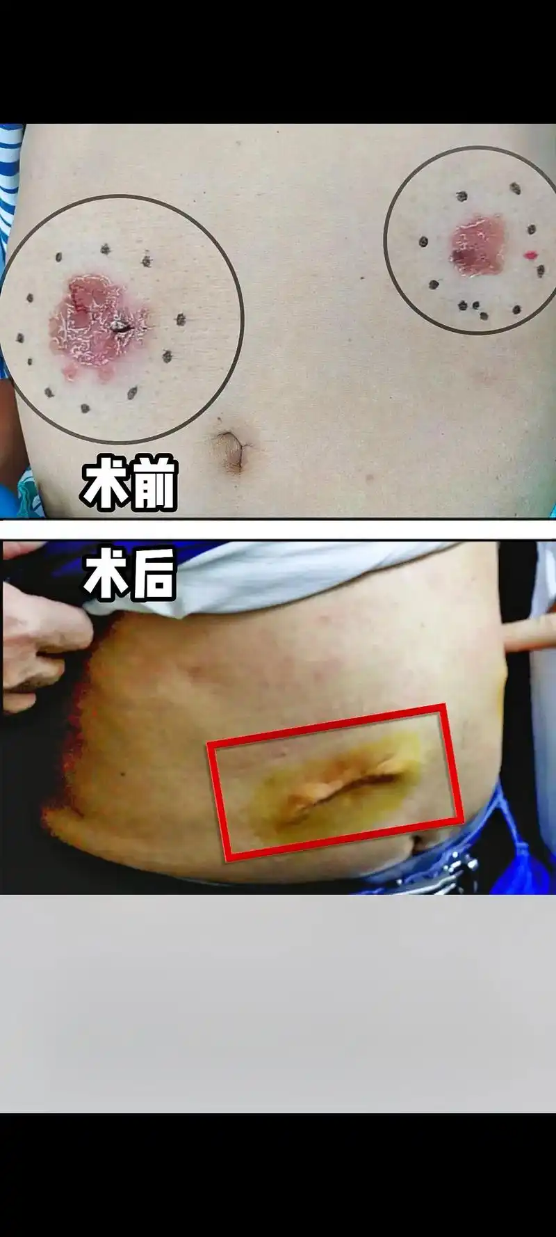 皮肤癌 - 抖音