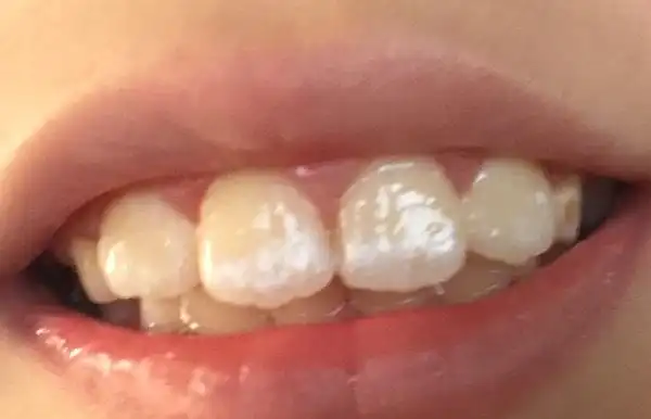 8岁孩子刚换牙两年,牙齿上就有白色的花点牙斑,去当地医院看过,医生就